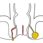 Manejo quirúrgico de fistula anal