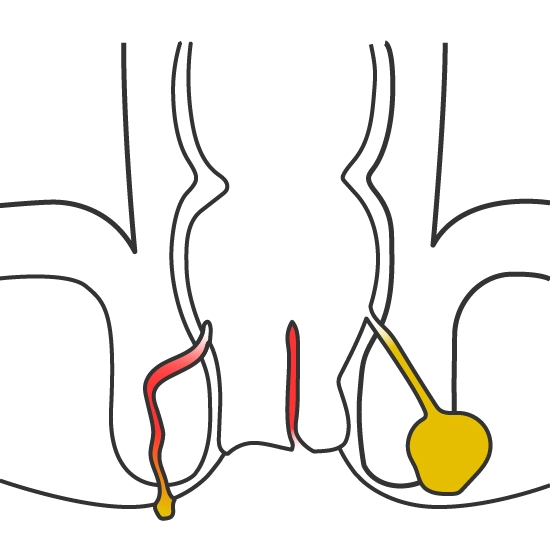 Absceso y fístula anal