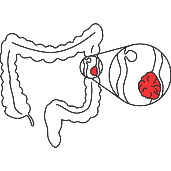 Cáncer de colon y recto