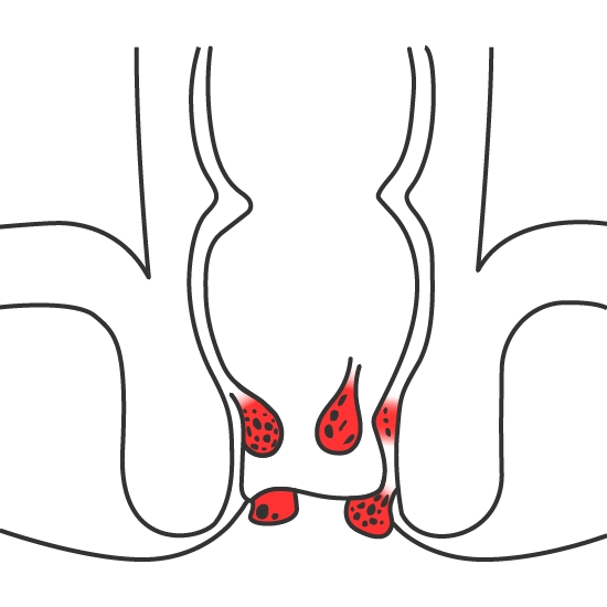 Hemorroides