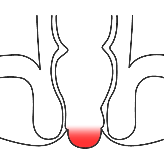 Prolapso rectal